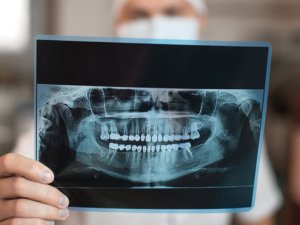 Diş röntgeninde radyasyon riskine karşı önlem şart
